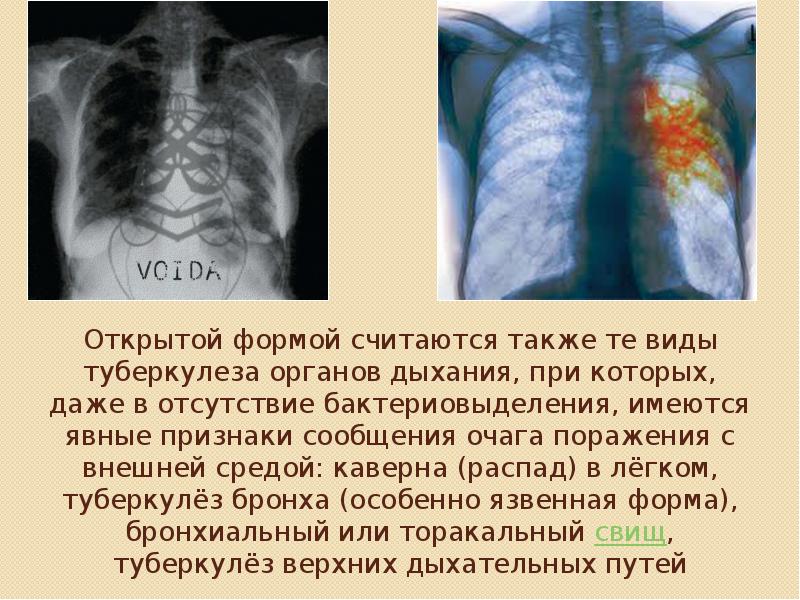 Костно суставной туберкулез презентация