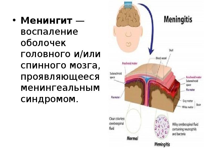 Менингит — воспаление оболочек головного и/или спинного мозга, проявляющееся менингеальным синдромом.