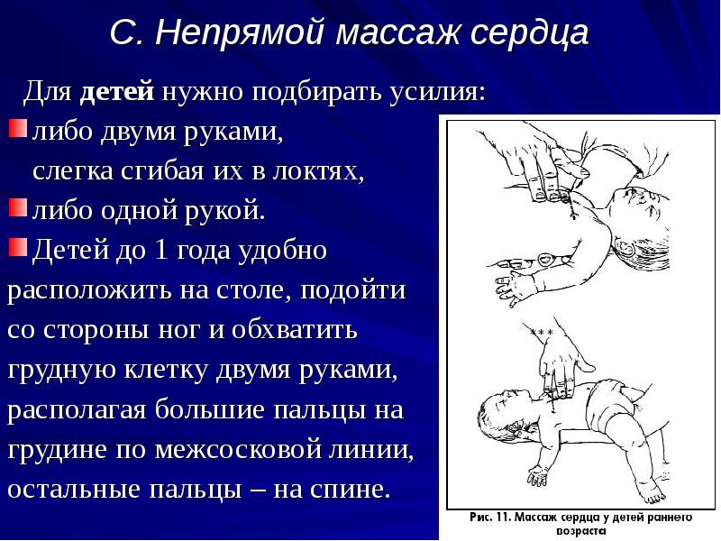 Ваши действия при непрямом массаже сердца