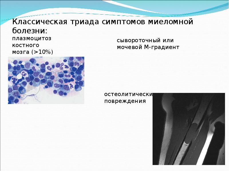 Миеломная болезнь костный мозг. М компонент при миеломной болезни это. Плазмоцитоз костного мозга. Триада миеломной болезни.