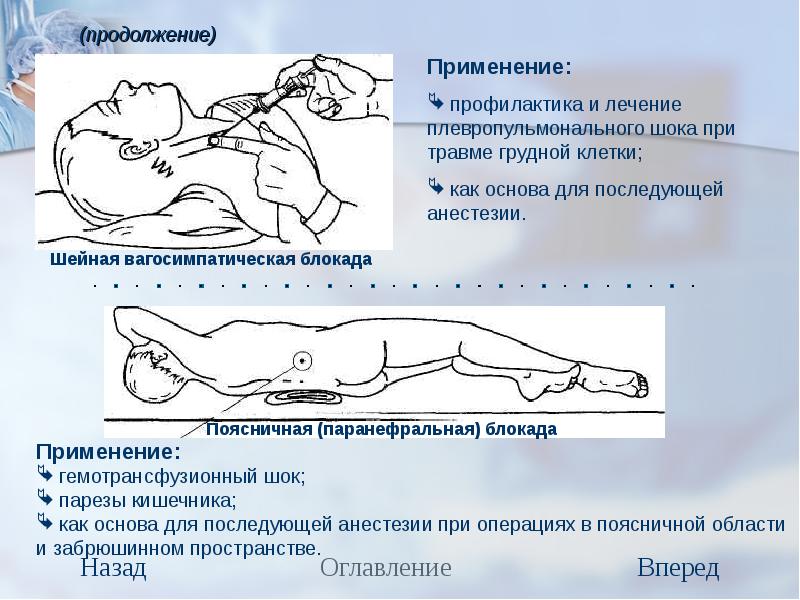 Концентрация новокаина для паранефральной блокады. Малрой местная анестезия. Шейная вагосимпатическая блокада. Лечение плевропульмонального шока. Местный анестезия при травмах.