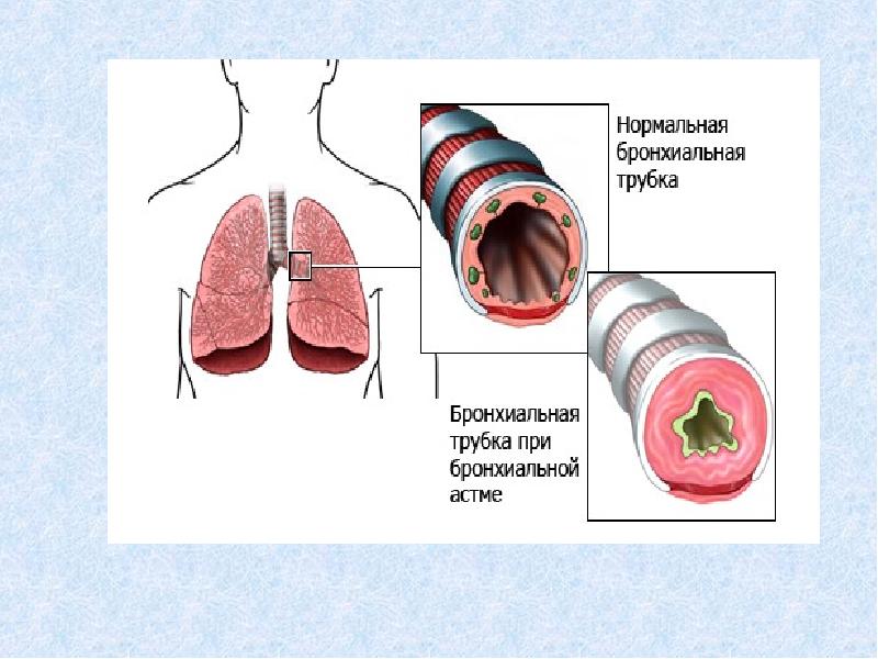 Диагностика бронхиальной астмы у детей презентация