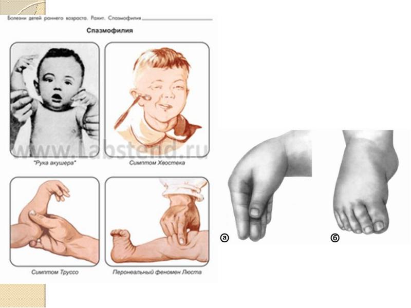 Спазмофилия у детей презентация