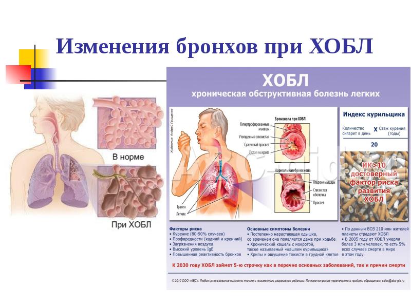 Хронический бронхит картинки для презентации