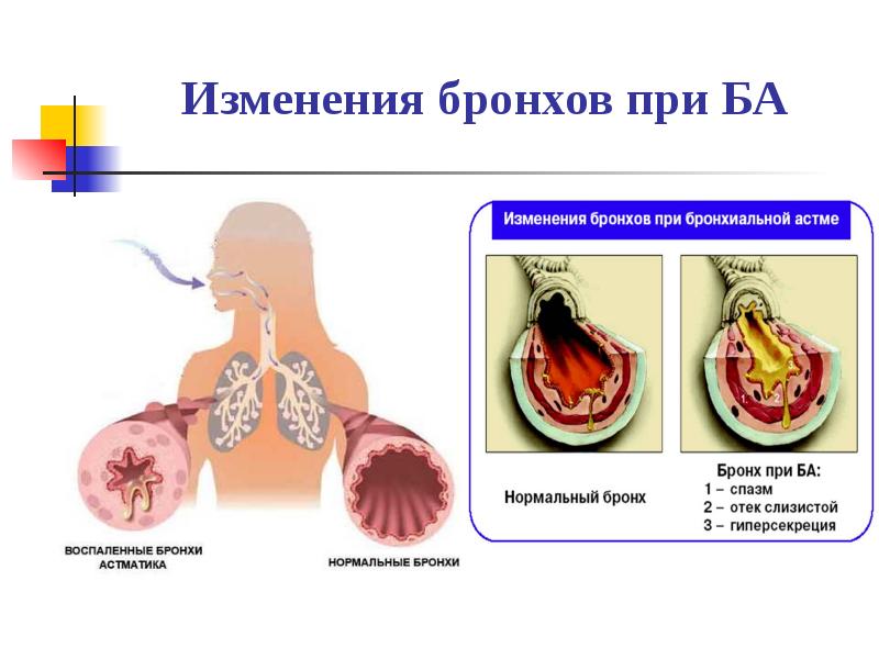 Бронхиальная астма презентация с картинками