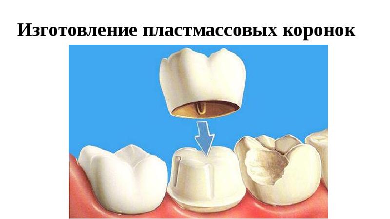 Изготовление цельнолитого мостовидного протеза презентация