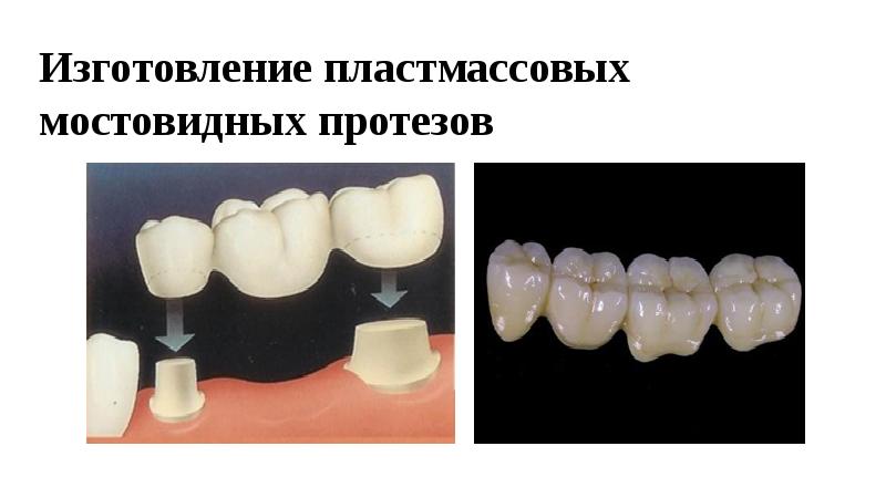 Изготовление мостовидных протезов презентация