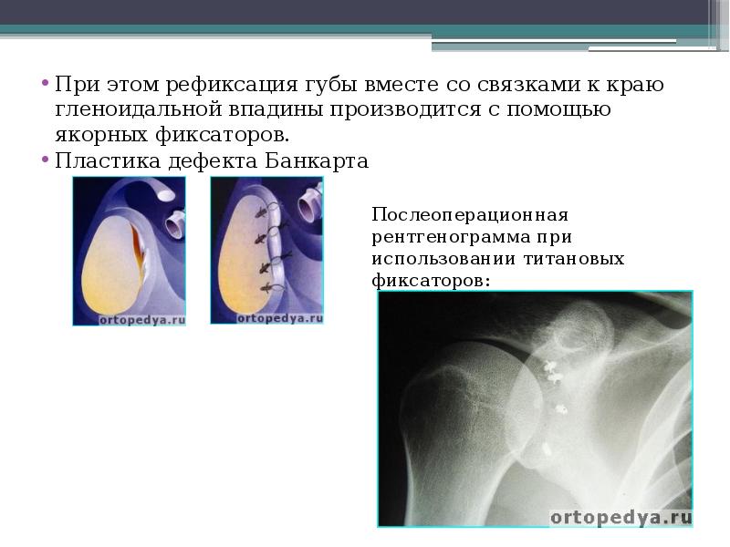 Артроскопия плечевого сустава презентация