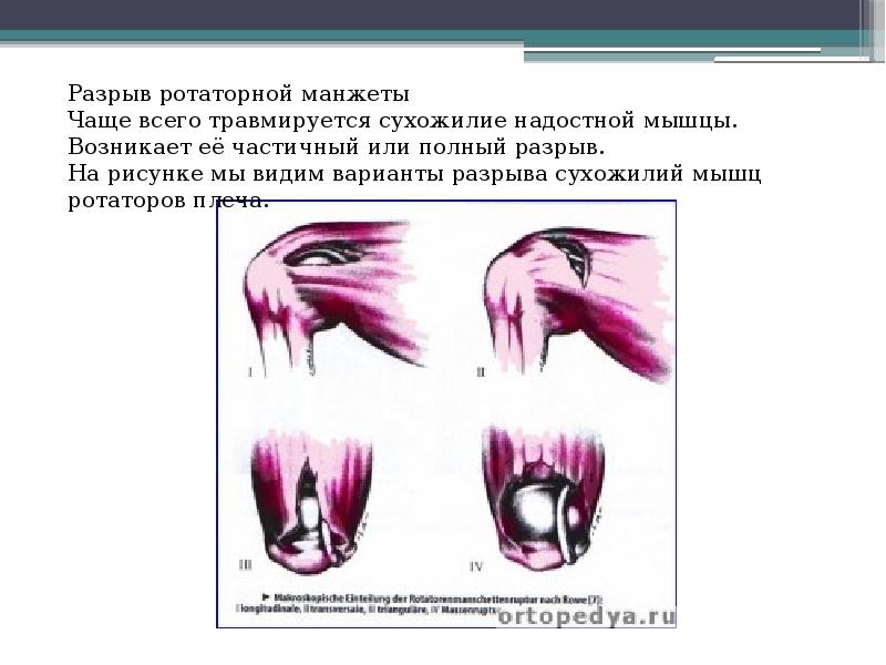 Артроскопия плечевого сустава презентация