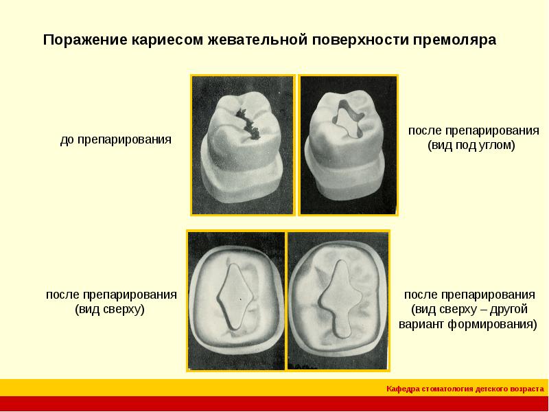 Классификация кариозных полостей по блэку презентация