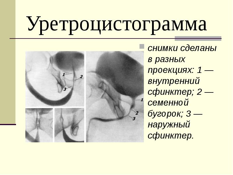 Уретроцистограмма снимки сделаны в разных проекциях: 1 — внутренний сфинктер; 2