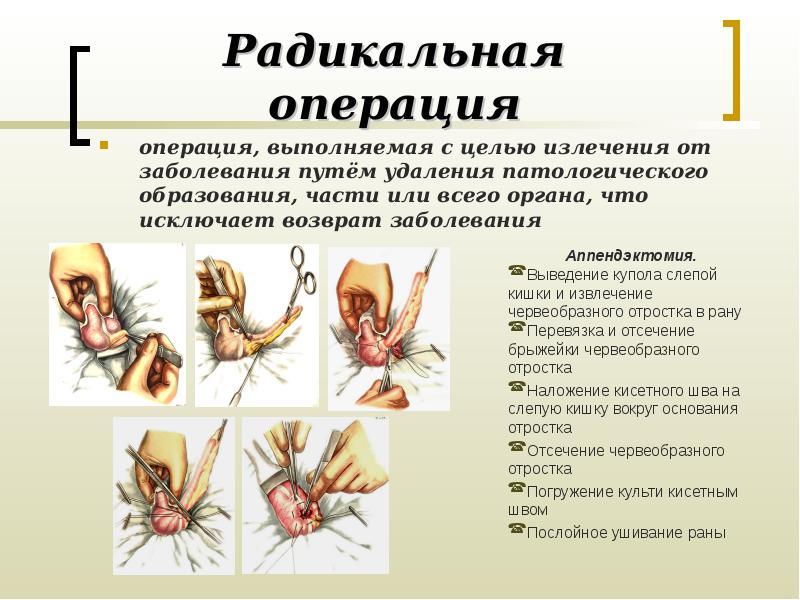 И операция значение операция определяет. Цель Радикальной операции. Радикальные операции примеры. Радикальные хирургические операции.