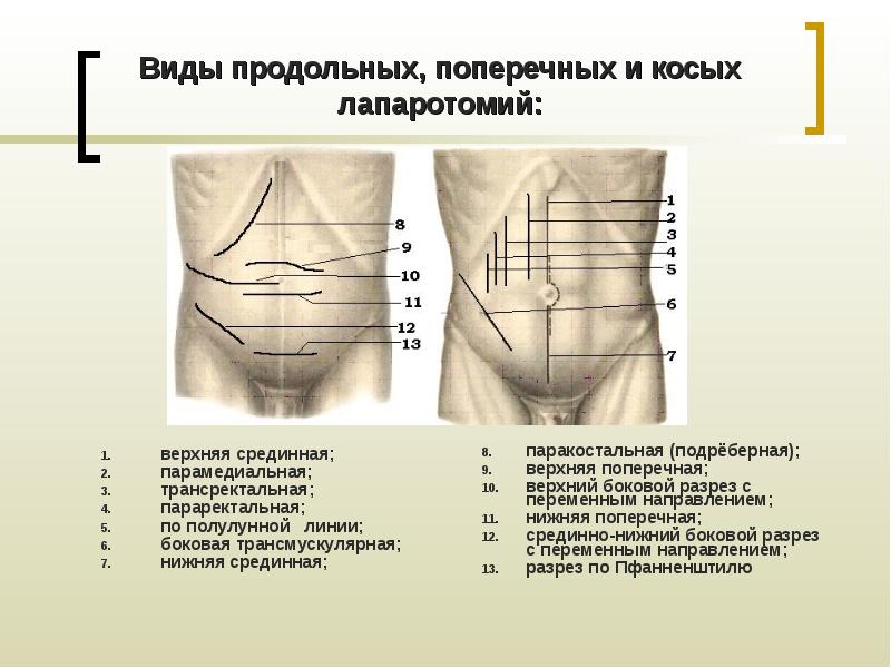 Операция пдр схема