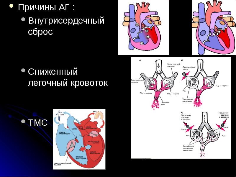 Нарушение внутрисердечной гемодинамики. Общий артериальный ствол гемодинамика. Легочный кровоток. Магистральный артериальный ствол. Общий артериальный ствол у плода.