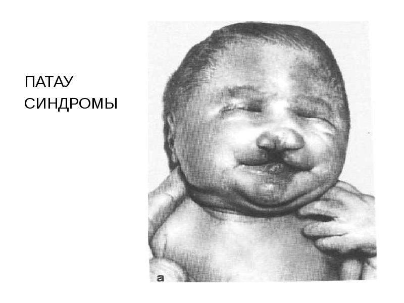 ПАТАУ  ПАТАУ  СИНДРОМЫ