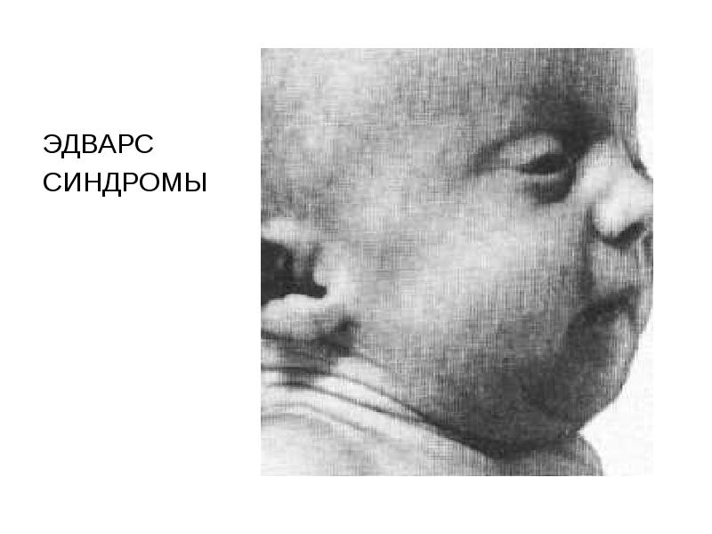 ЭДВАРС  ЭДВАРС  СИНДРОМЫ