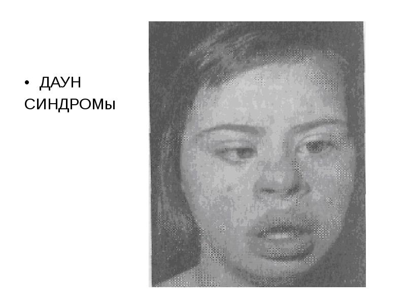 ДАУН  ДАУН  СИНДРОМы
