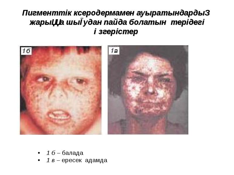 Пигменттік ксеродермамен ауыратындардың жарыққа шығудан пайда болатын терідегі өзгерістер  1