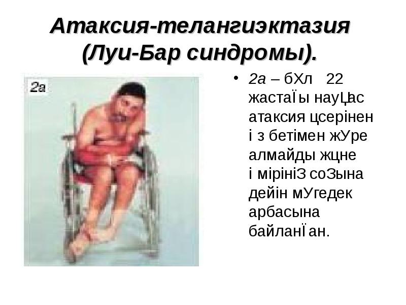 Атаксия-телангиэктазия (Луи-Бар синдромы).  2а – бұл  22 жастағы науқас