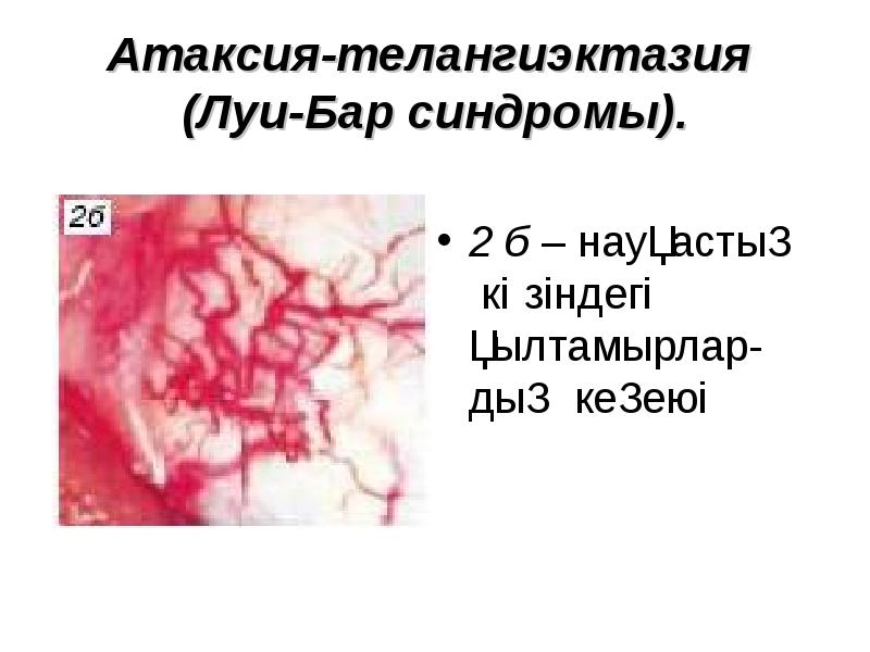 Атаксия-телангиэктазия (Луи-Бар синдромы). 2 б – науқастың  көзіндегі қылтамырлар-дың кеңеюі
