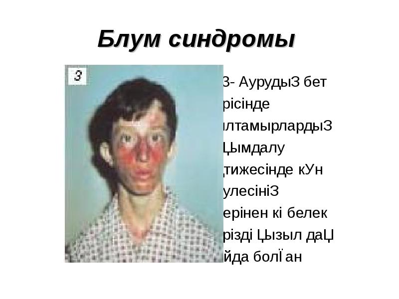 Блум синдромы  3- Аурудың бет терісінде қылтамырлардың зақымдалу нәтижесінде күн