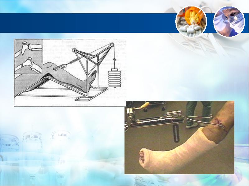 Лечение переломов презентация