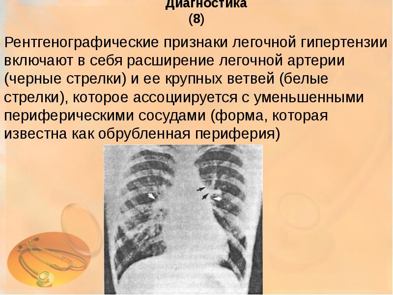 Легочная артериальная гипертензия презентация