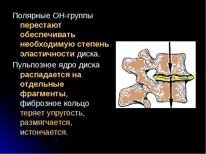 Остеохондроз позвоночника презентация