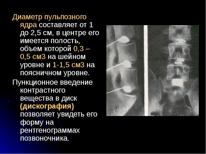 Остеохондроз позвоночника презентация