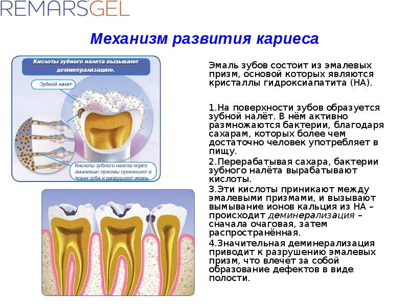 Заболевания зубов и полости. Стадии формирования зубного налета. Роль зубного налета в развитии кариеса. Факторы возникновения кариеса зубов. Болезни зубов: кариес, этиология,.