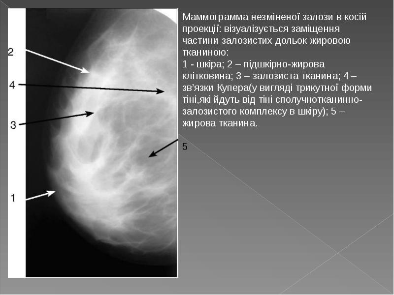 Описание маммограмм. Описание маммограммы. Маммограмма расшифровка. Схема описания маммограмм.