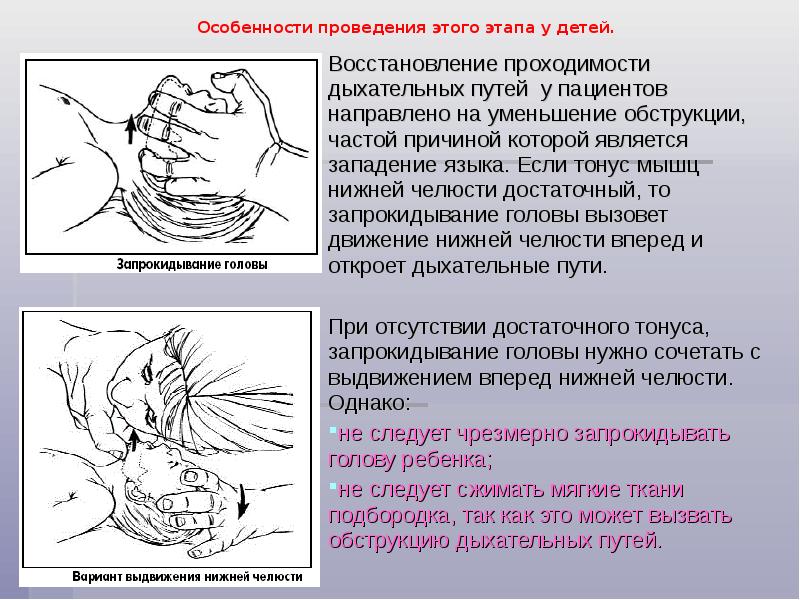 Восстановление проходимости дыхательных путей. Восстановление проходимости дыхательных путей , западение языка. Этапы восстановления проходимости дыхательных путей. Положение ребенка для восстановления проходимости дыхательных путей. Неотложная помощь при западении языка.