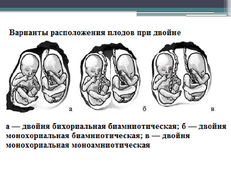 Двойной плод. Многоплодная дихориальная беременность. Монохориальная биамниотическая двойня. Варианты расположения плодов при двойне. Беременность монохориальная диамниотическая двойня.