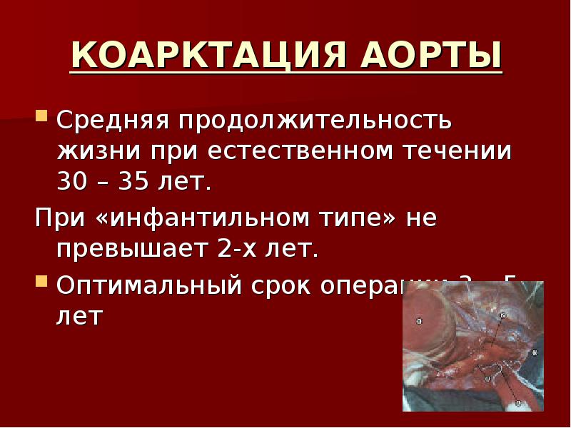 Коарктация аорты отзывы