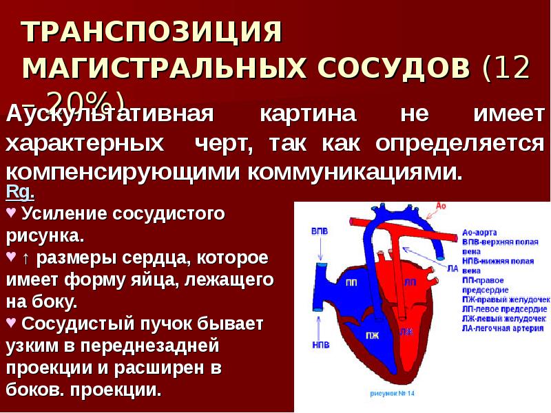 Транспозиция артерии