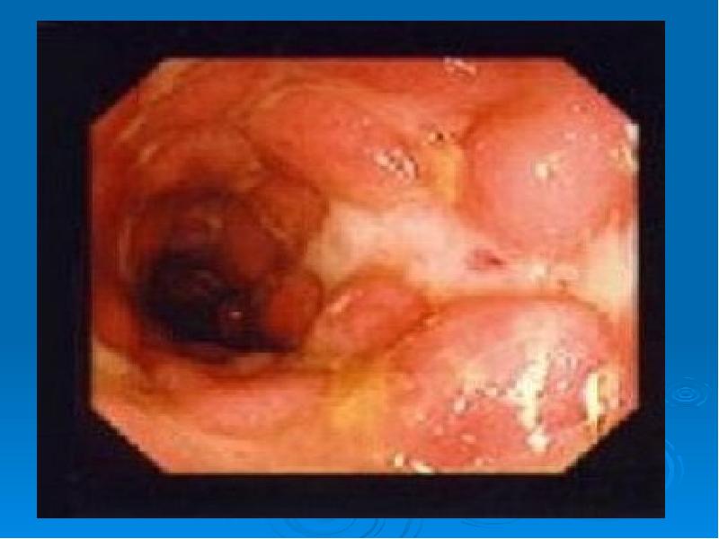 Язвенный колит болезнь крона презентация