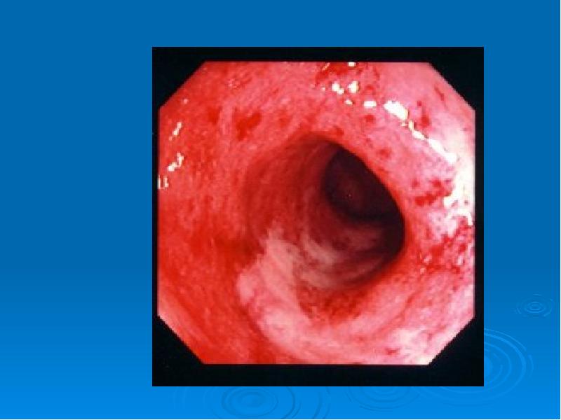 Язвенный колит болезнь крона презентация