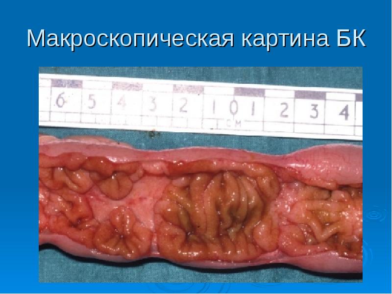 Язвенный колит болезнь крона презентация