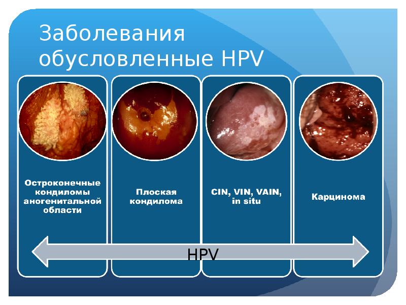 Схема лечения впч