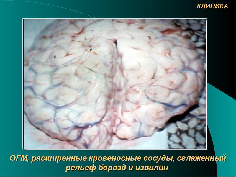 Менингококковая инфекция презентация