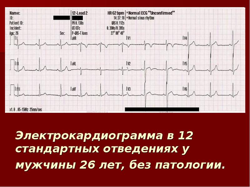 Нормальное экг фото во всех отведениях с расшифровкой