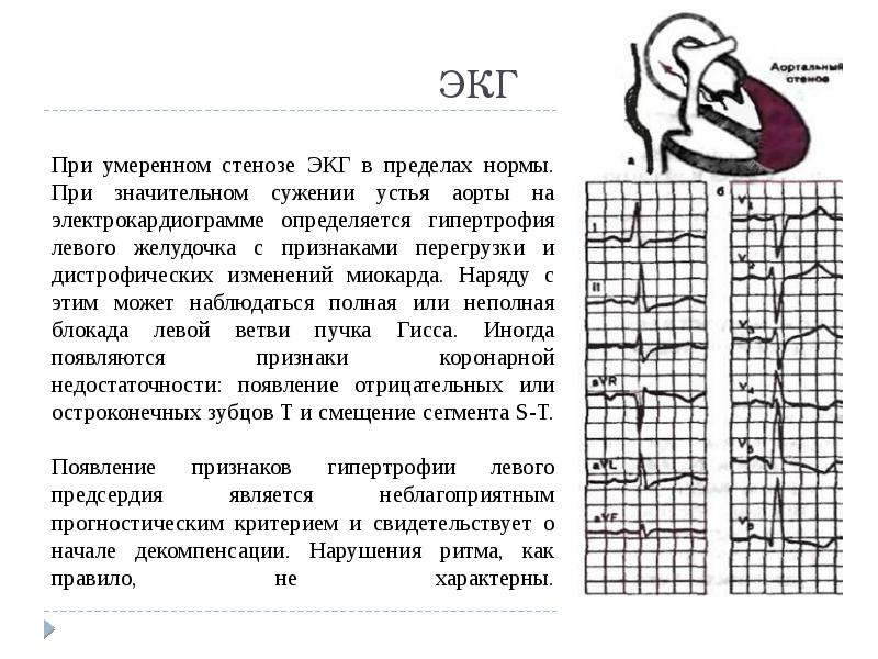 умеренный стеноз. пороки митрального и аортального клапанов. стеноз аортального клапана экг. дегенеративный аортальный стеноз. подклапанный стеноз устья аорты.