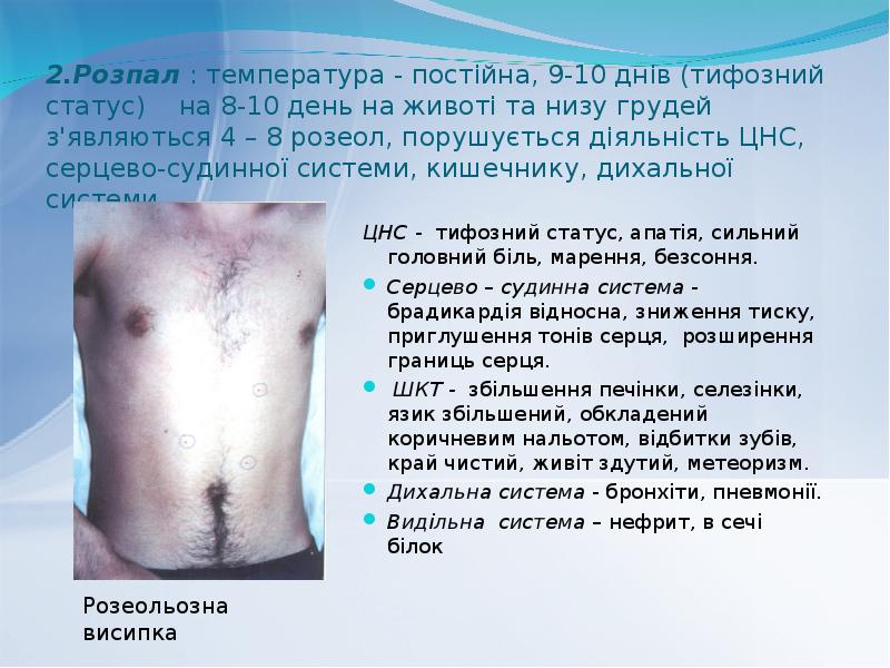 2.Розпал : температура - постійна, 9-10 днів (тифозний статус) на 2.Розпал : температура - постійна, 9-10 днів (тифозний статус) на