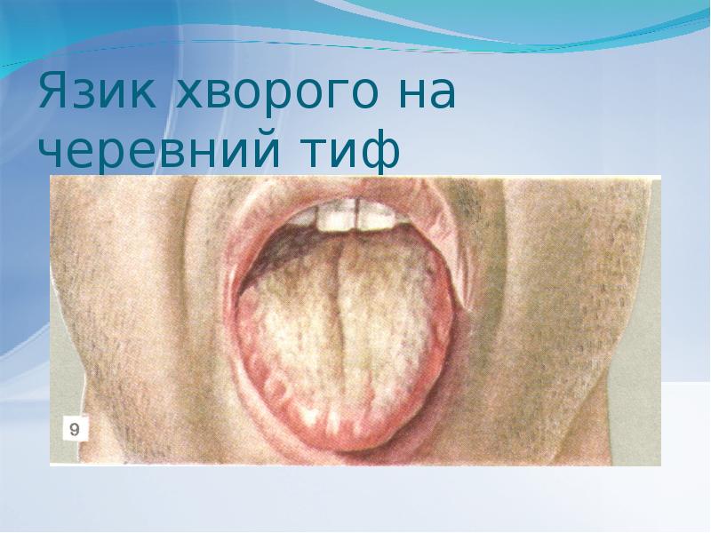Язик хворого на черевний тиф Язик хворого на черевний тиф