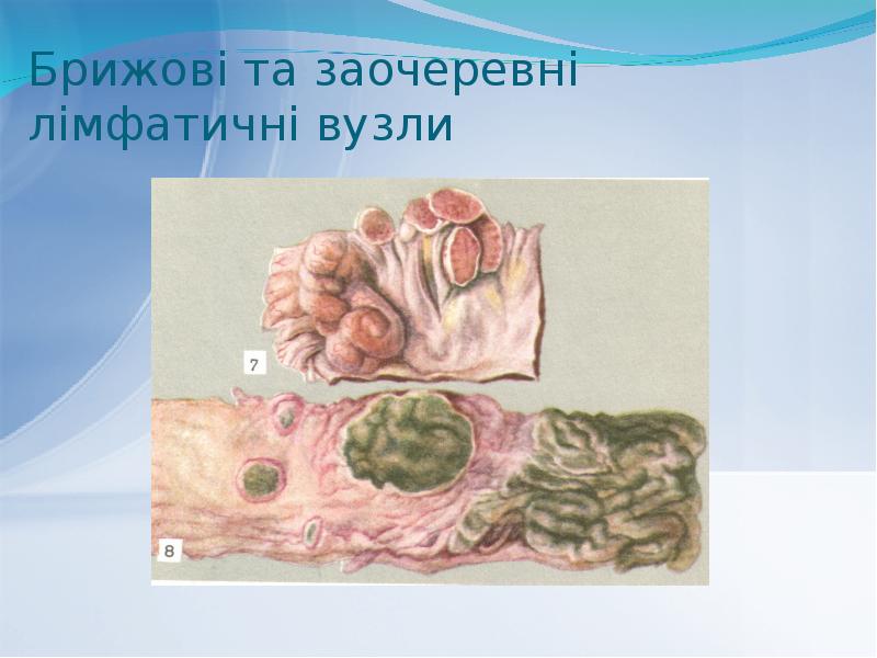 Брижові та заочеревні лімфатичні вузли Брижові та заочеревні лімфатичні вузли