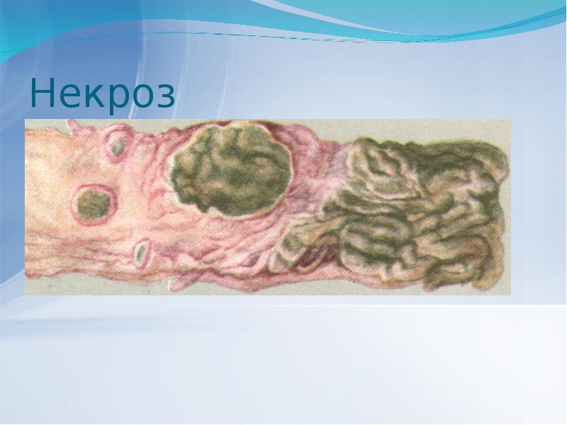 Некроз Некроз