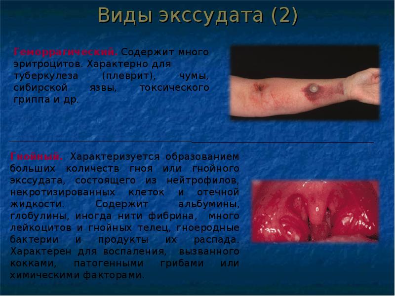 Презентация на тему патофизиология воспаления