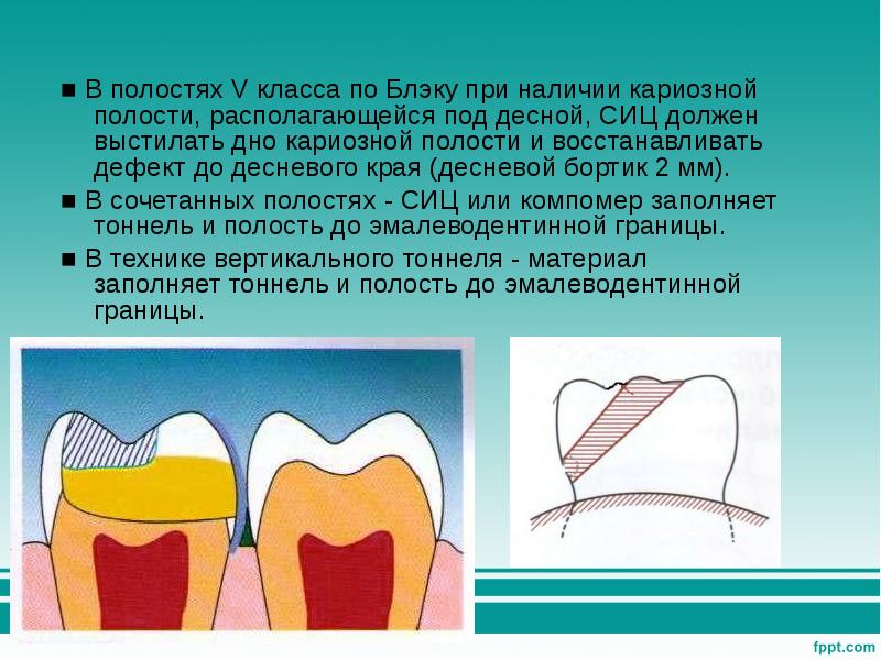 Препарирование кариозной полости 1 класса