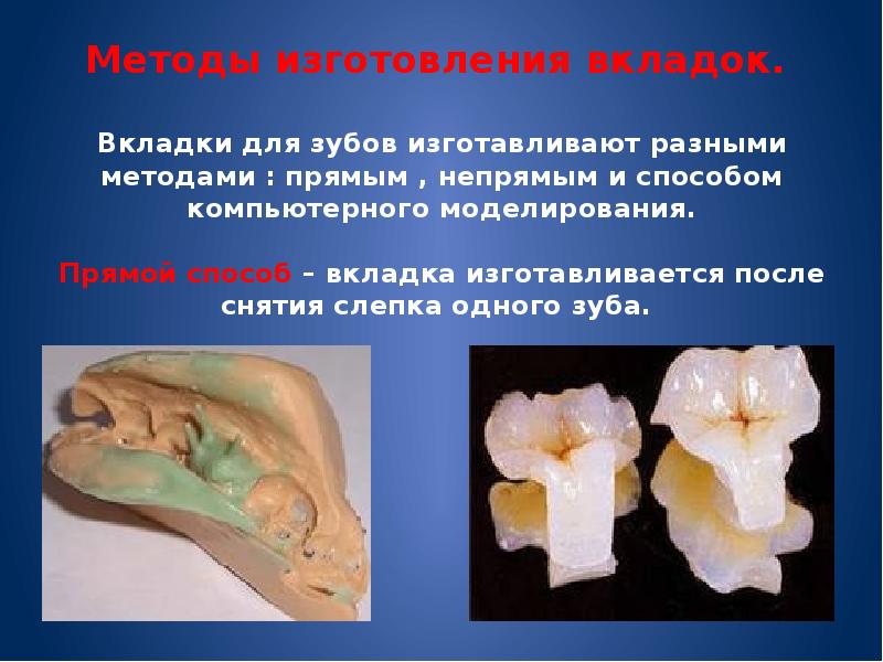 Косвенный метод изготовления вкладок презентация