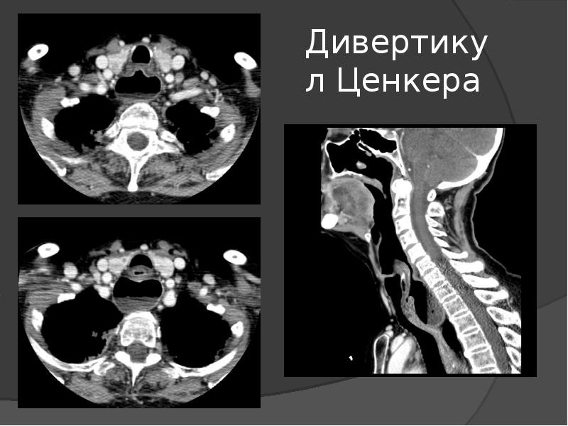 Дивертикул стенки трахеи